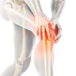 Knee Arthritis Program: